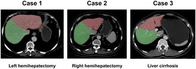 A deep learning model for prediction of post hepatectomy liver failure after hemihepatectomy using preoperative contrast-enhanced computed tomography: a retrospective study